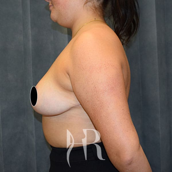 HR Plastic Surgery - Breast Reduction patient after 3